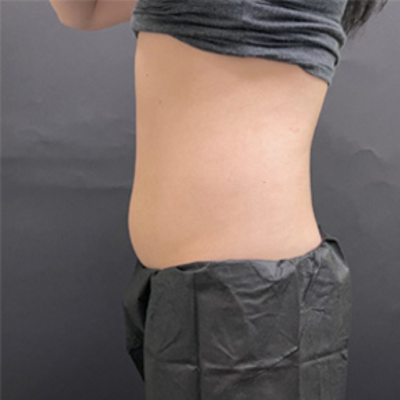 Before EmSculpt treatment