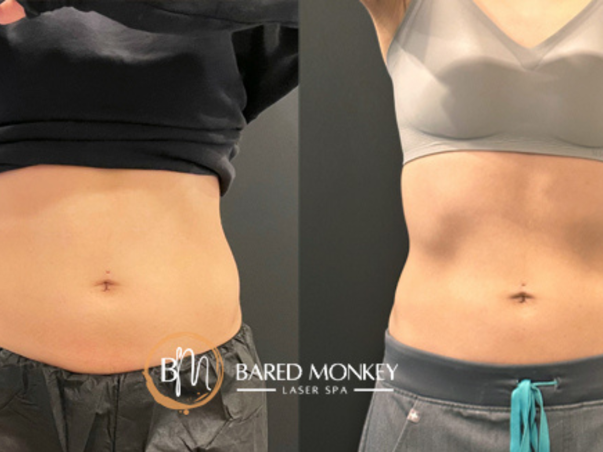 Lasting EmSculpt before and after result